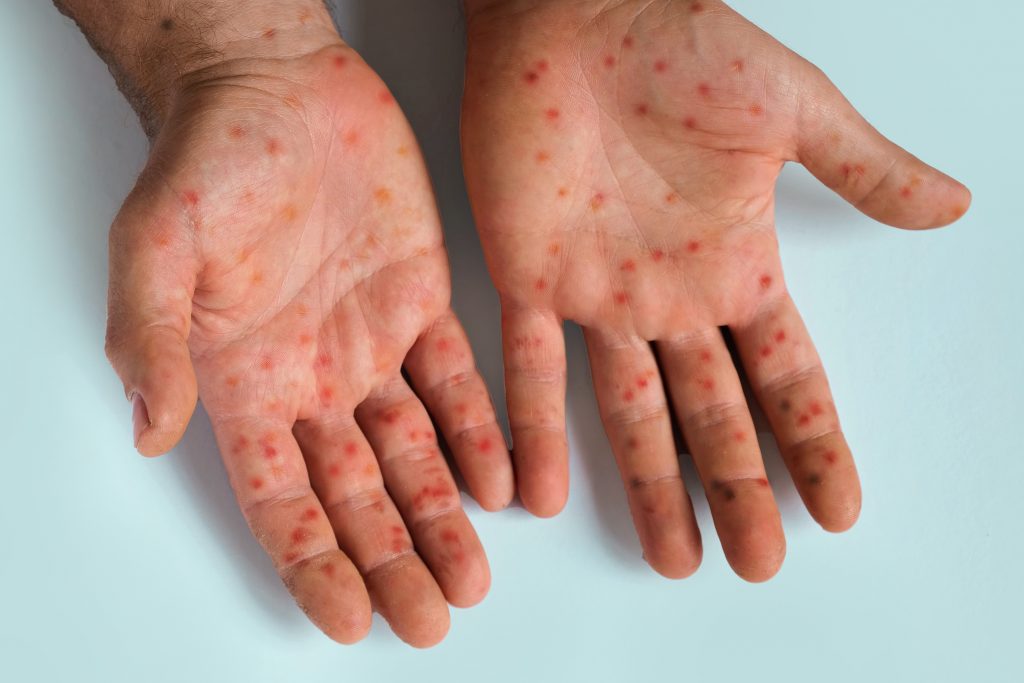 Mpox Outbreak Current Status and Ongoing Response Efforts(11 July 2024)
