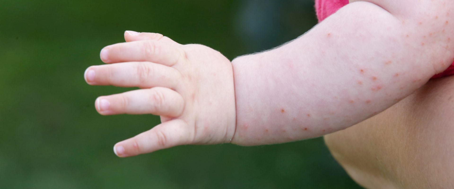 Baby rash caused by fever, insect bite, skin allergy or heat reaction Baby rash caused by fever, insect bite, skin allergy or heat reaction